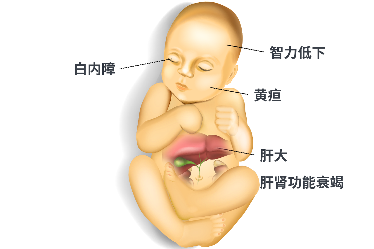 半乳糖血症患者图片 经典半乳糖血症