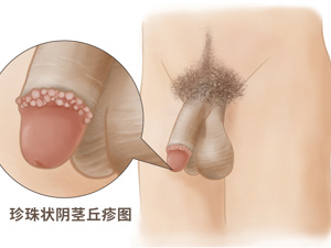 冠状沟皮脂腺异位图片 口腔皮脂腺异位图