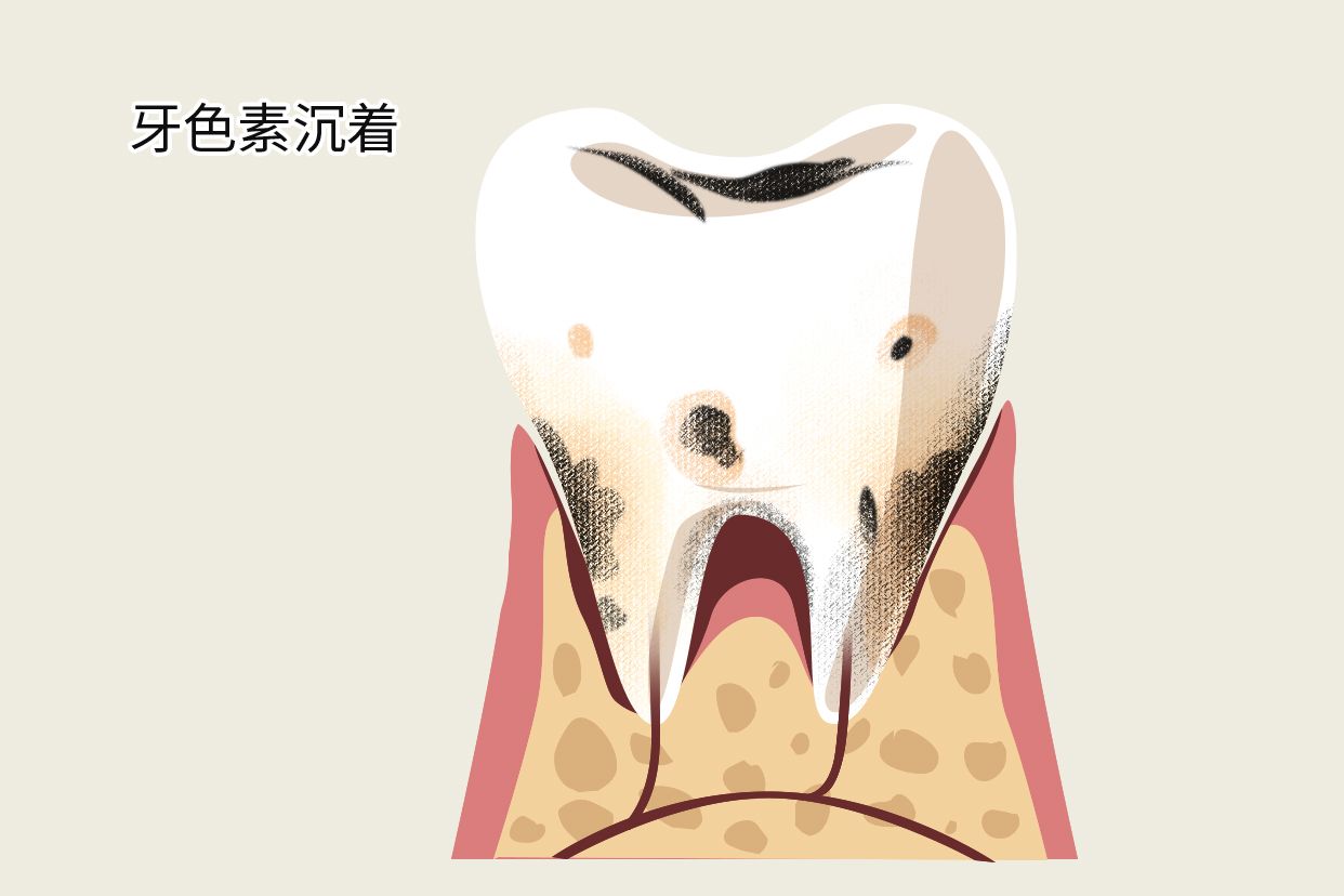 牙色素沉着和龋齿区别有图吗（牙齿色素沉积和龋齿区别）