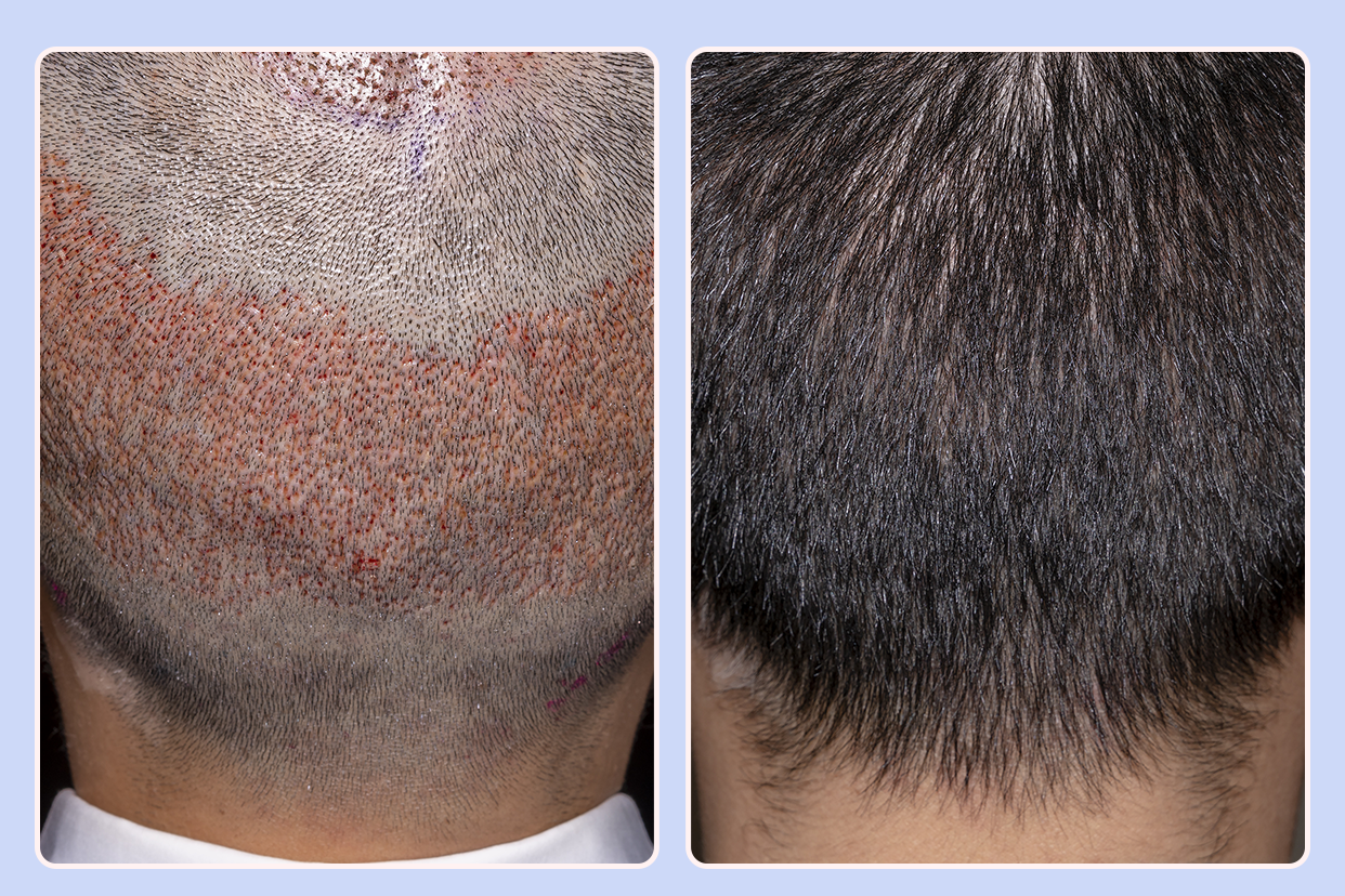 植发半个月后取发区图片 植发后取发区多久能恢复正常