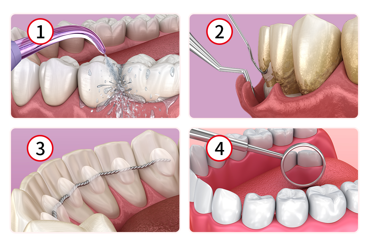 牙周治疗四个步骤图解（牙周治疗操作流程）