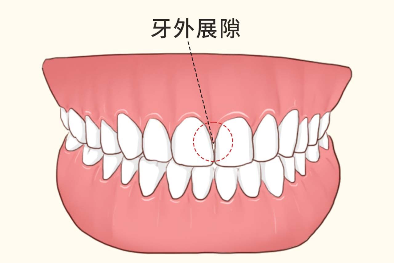 牙外展隙图解 牙齿的外展隙图解
