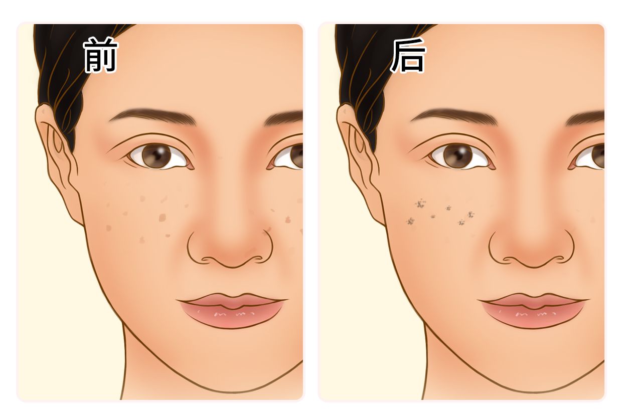 黑金超光子后结痂图（黑金超光子后结痂图解）