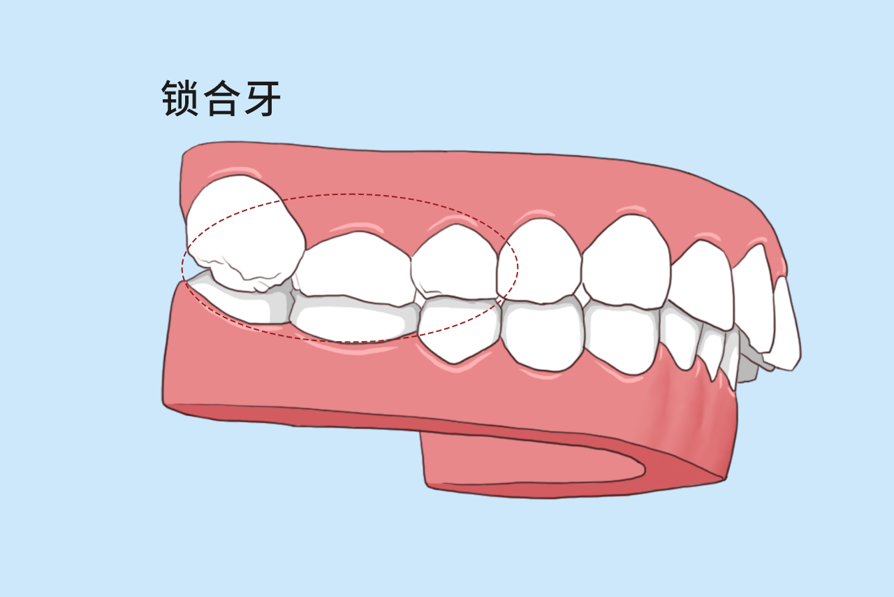 锁合牙图片（锁合牙松动）