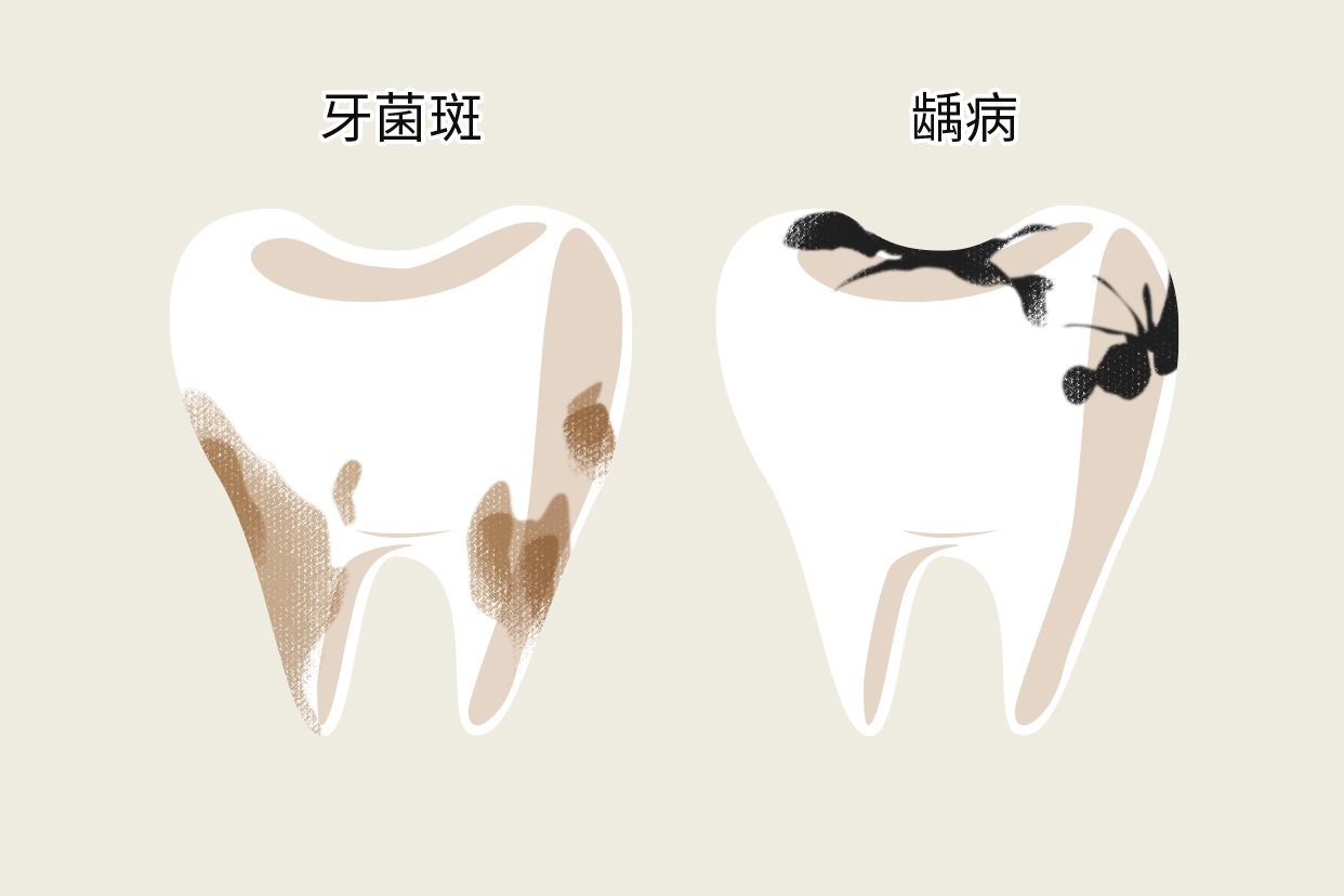 牙垢和蛀牙的区别图片 牙垢和蛀牙的区别图片对比