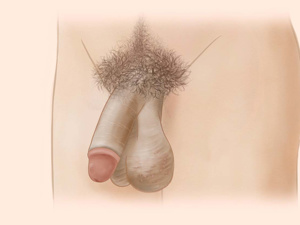 阴囊皮肤粗糙变厚图片 阴囊皮肤粗糙变厚图片