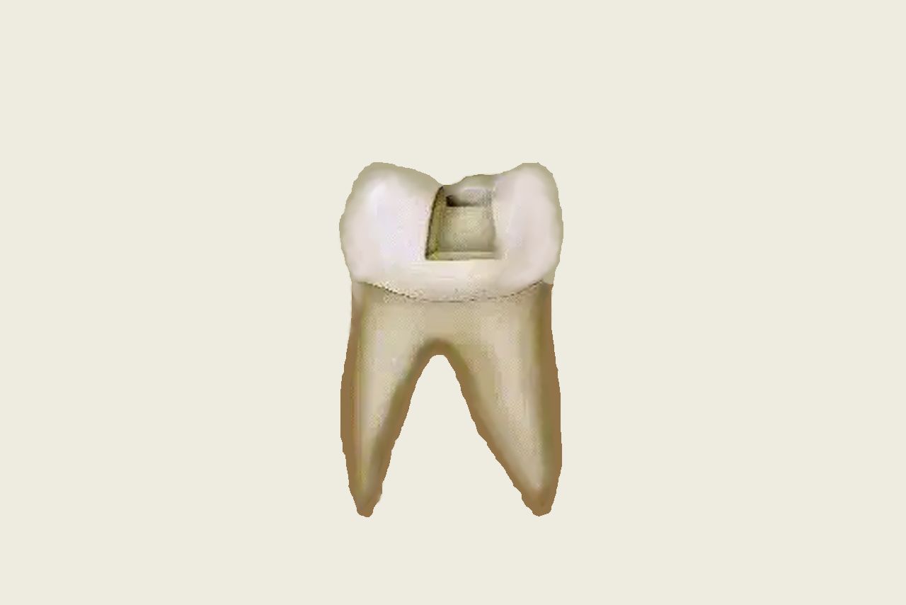 口腔二类洞龈壁图解 口腔二类洞龈壁图解