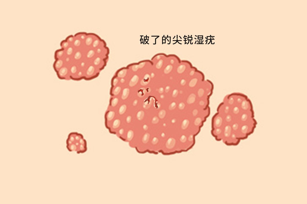 破了的尖锐湿疣图片 破了的尖锐湿疣图片