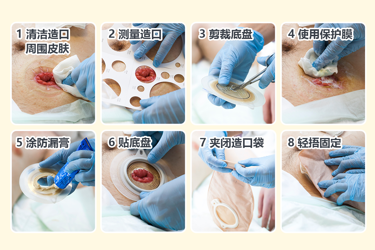 造口更换流程图 造口更换流程图