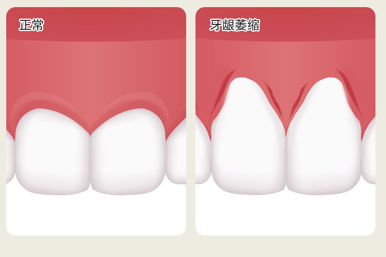 正常没萎缩的牙龈图片