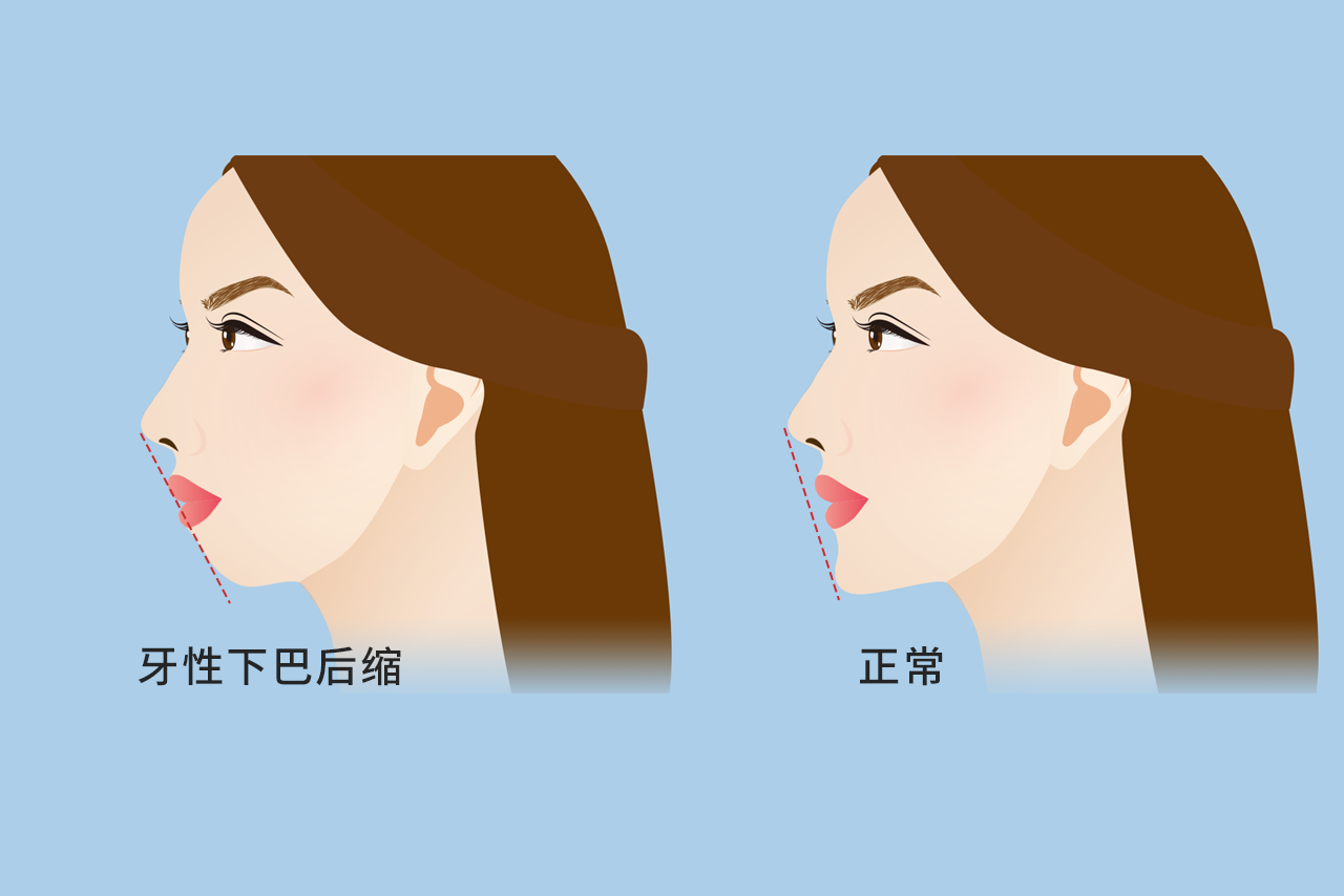 牙性下巴后缩图片