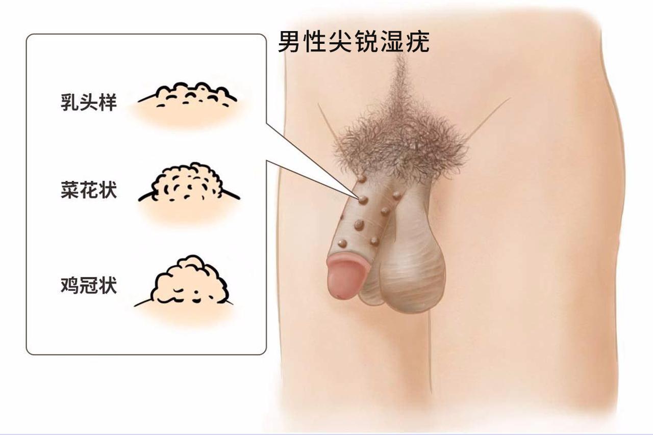 尖锐湿疣症状图（隐私外面长了个疙瘩是怎么回事）