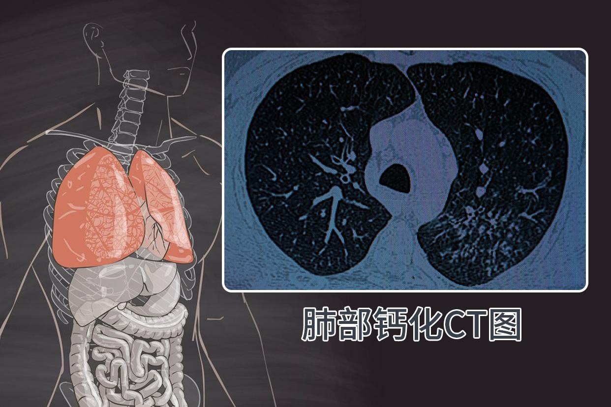 肺部钙化ct图像啥样的（肺部钙化ct图片）
