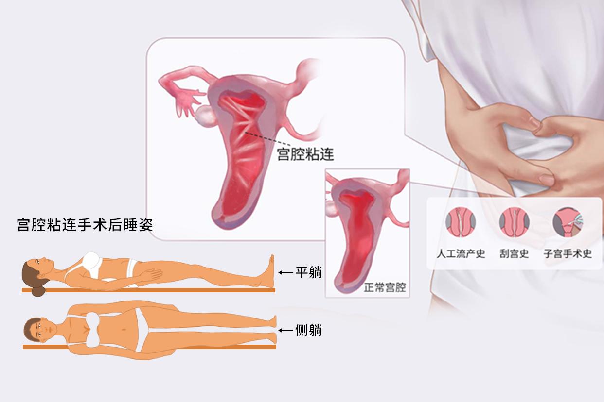 宫腔粘连手术后睡姿正确图片（宫腔粘连术后睡觉姿势）