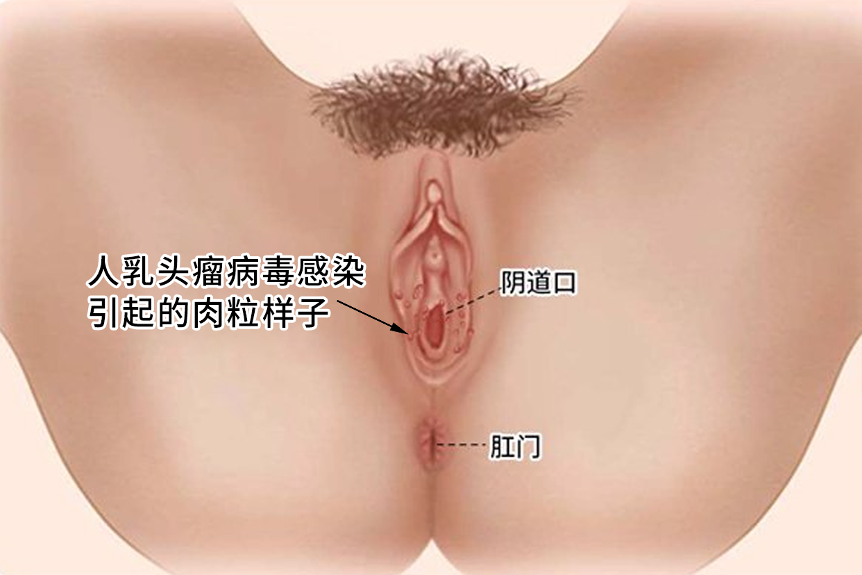 hpv的肉粒是什么样的（hpv肉粒怎么处理）