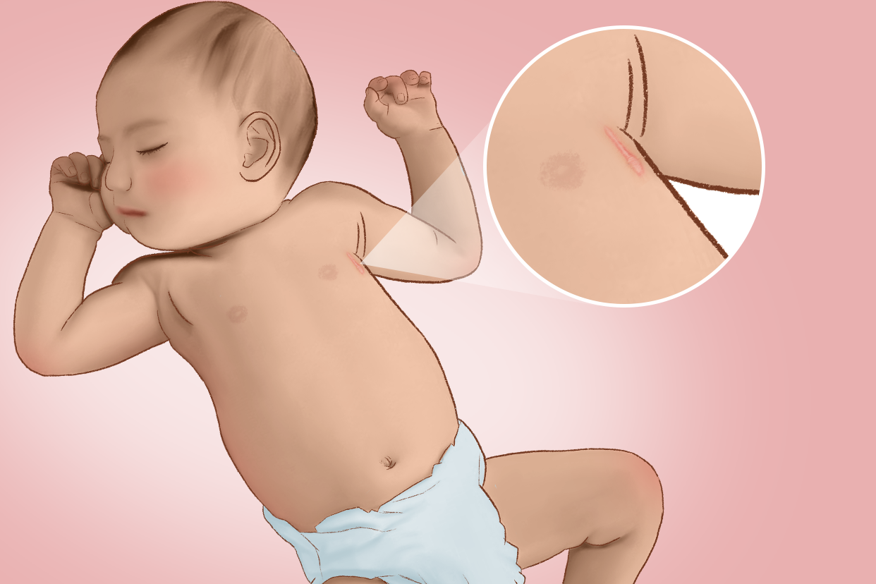 宝宝心脏手术疤痕图片 宝宝心脏手术疤痕图片真实