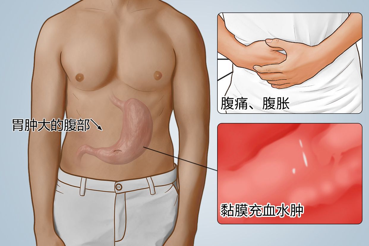 胃肿大的腹部图片 胃肿大有什么症状