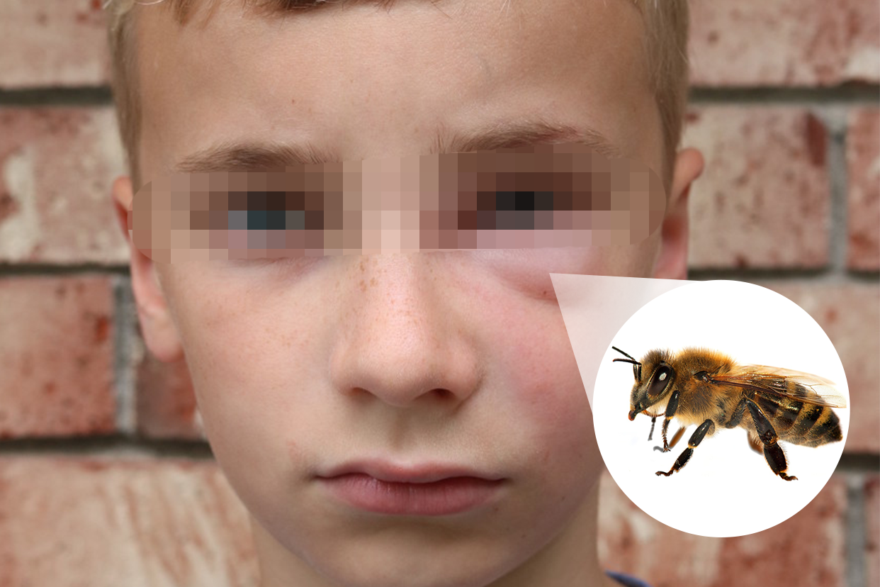 小孩被蜜蜂蛰了肿图片（小孩被蜜蜂蛰了怎么消肿止痒）