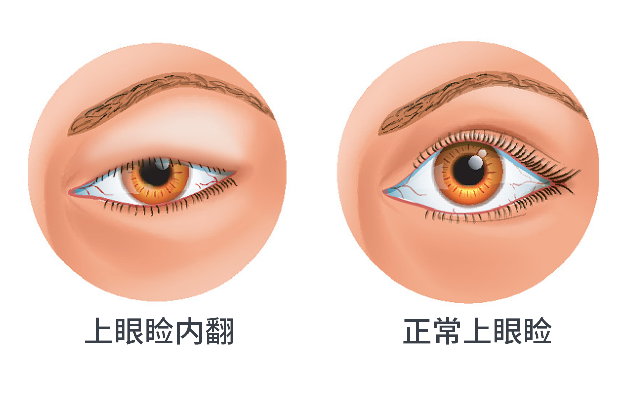 上眼睑内翻图 上眼睑内翻图片女