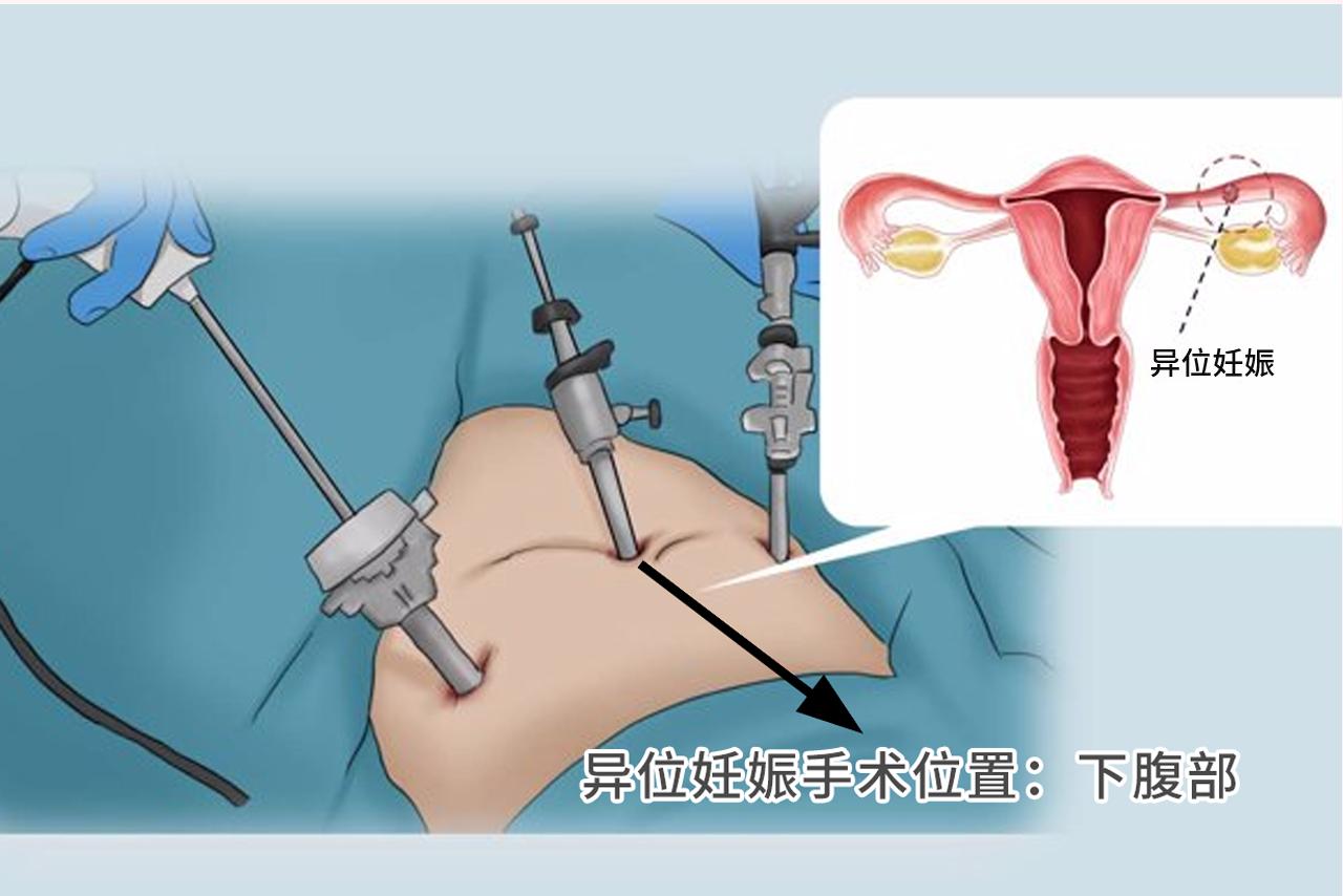 宫外孕手术在哪里开刀图 宫外孕手术在哪个部位开刀