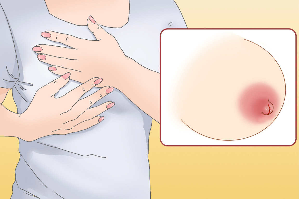 哺乳期乳裂图片 哺乳期裂奶如何治疗