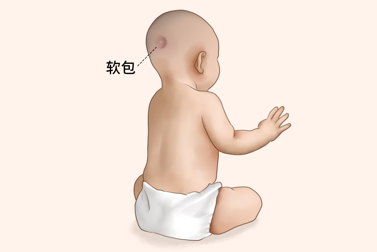 6个月婴儿后脑有个软包图片 六个月的婴儿后脑勺有个鼓起来的小包