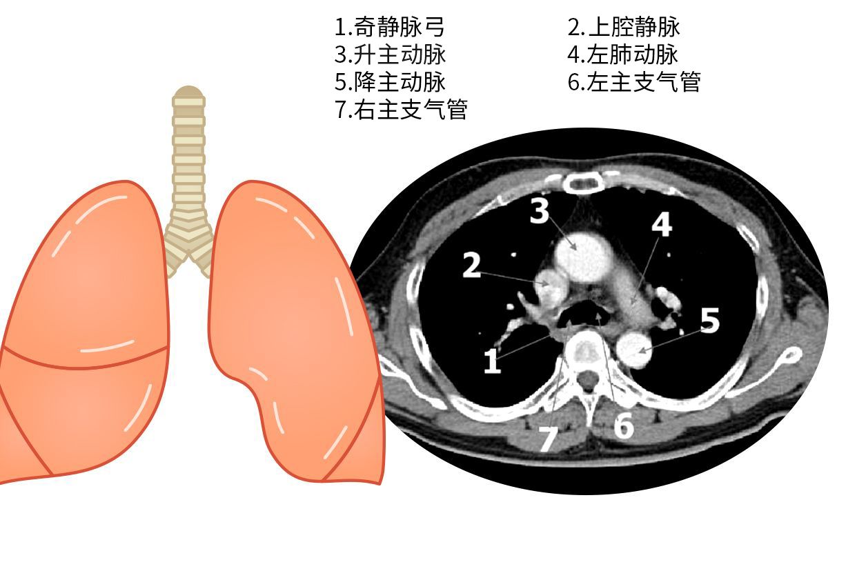 主动脉肺动脉窗图片（主肺动脉窗的内容）
