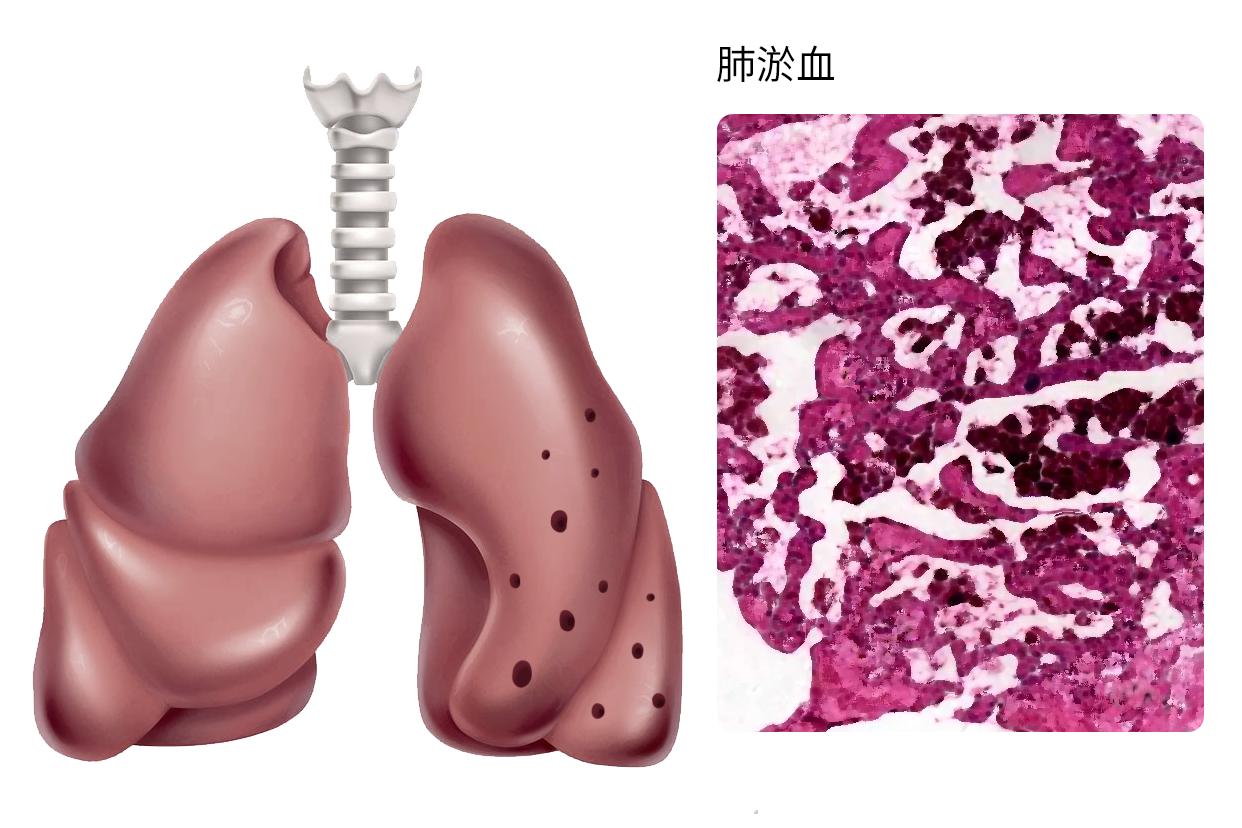 肺淤血图片 肺淤血图片红蓝铅笔