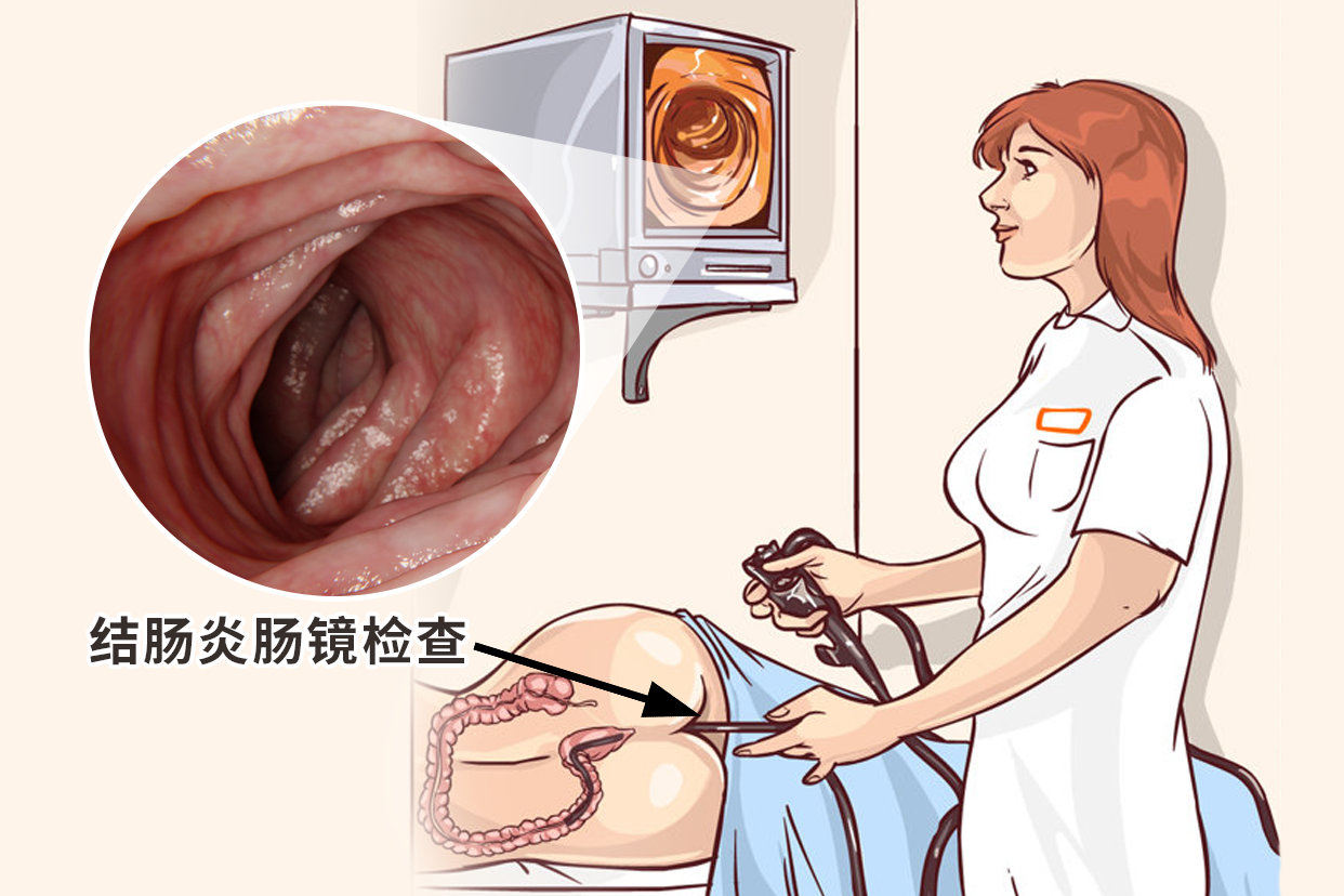 结肠炎肠镜检查图片 结肠炎的肠镜图片