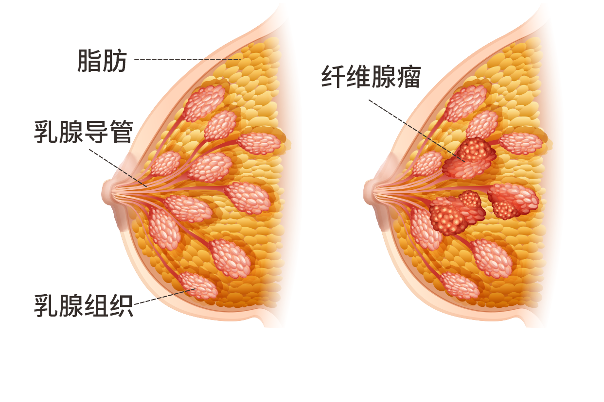 乳房上方纤维瘤图片（乳房上方纤维瘤图片女性）