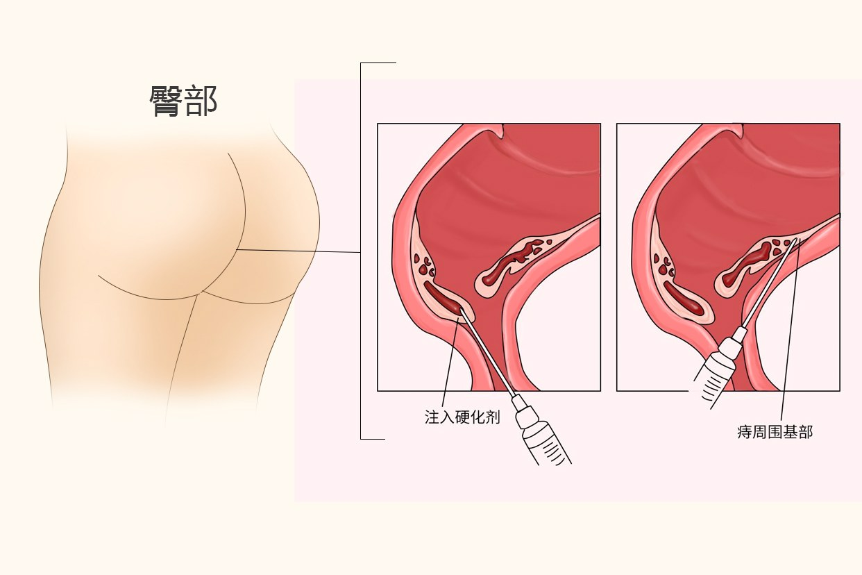 痔疮打针后一个星期后图片（痔疮打针后一个星期了还流血）