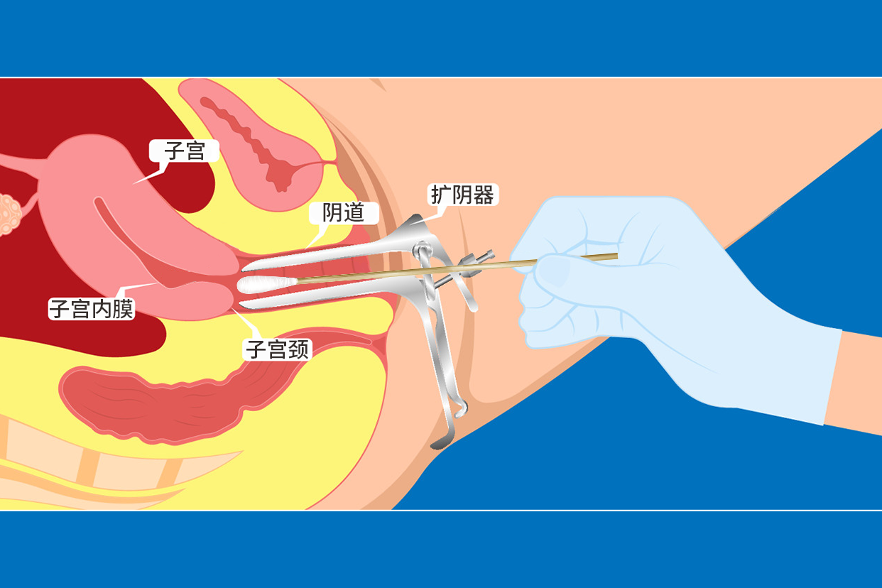 扩阴器阴道上药图片（扩阴器上药会不会有伤害）