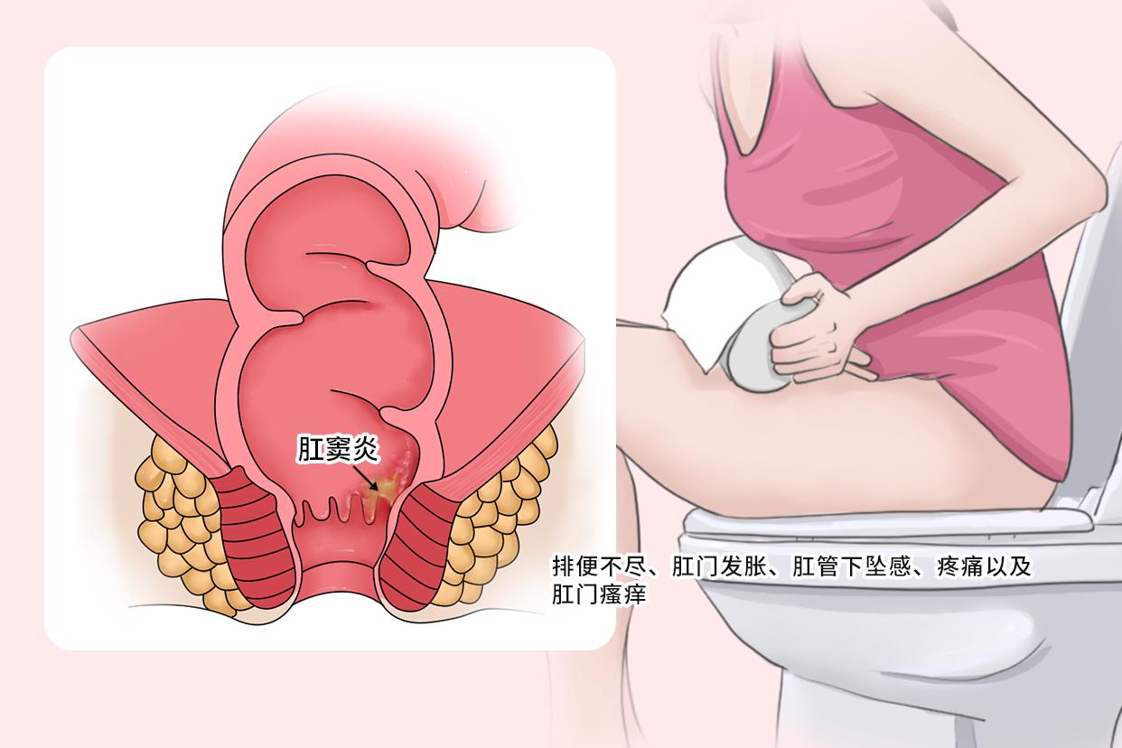 女性肛窦炎的症状图片（肛窦的位置肛窦炎图片）