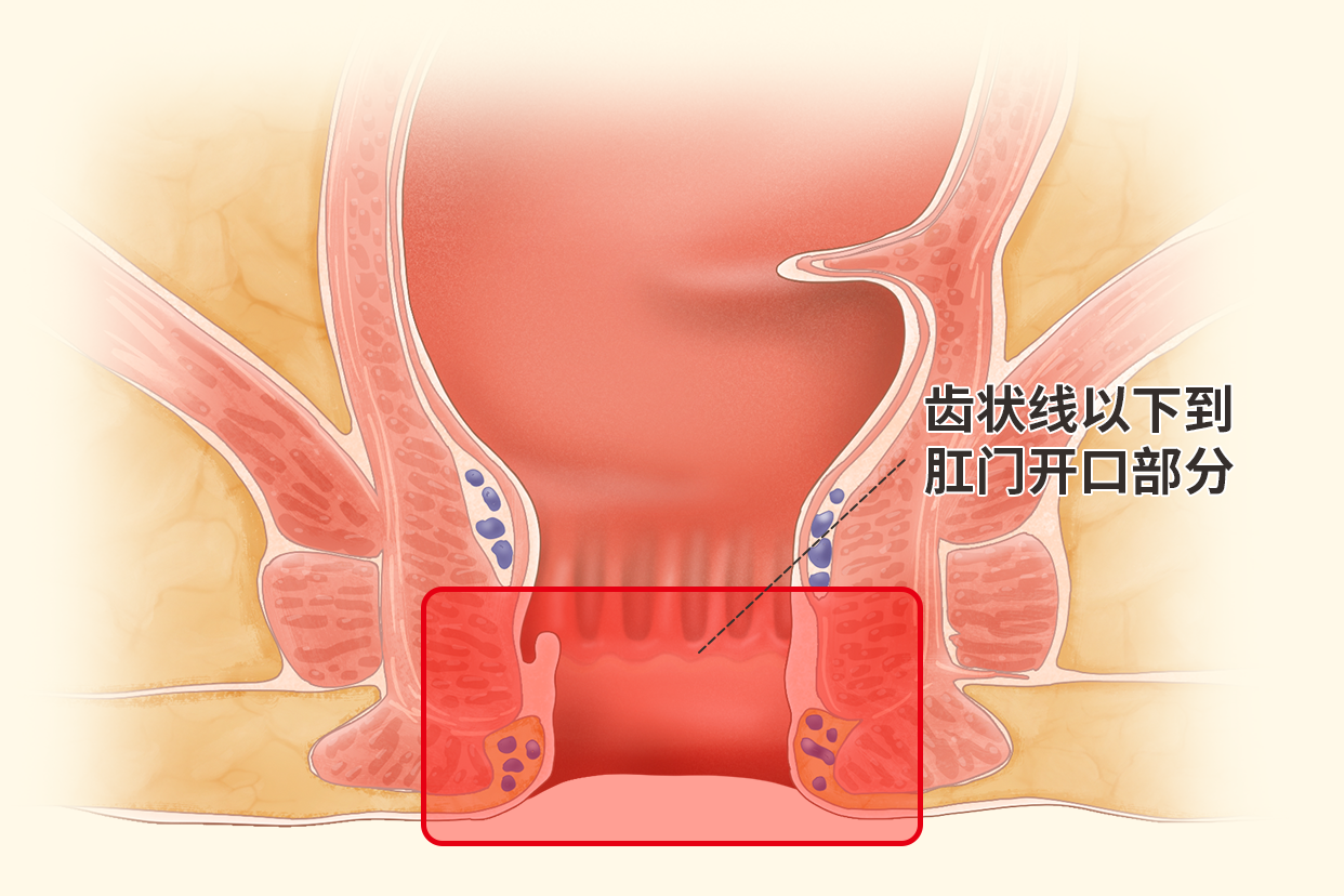 肛管癌位置图片 肛管癌的临床表现