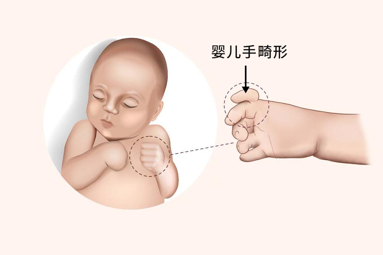 婴儿手畸形图片（婴儿手畸形可以恢复吗）