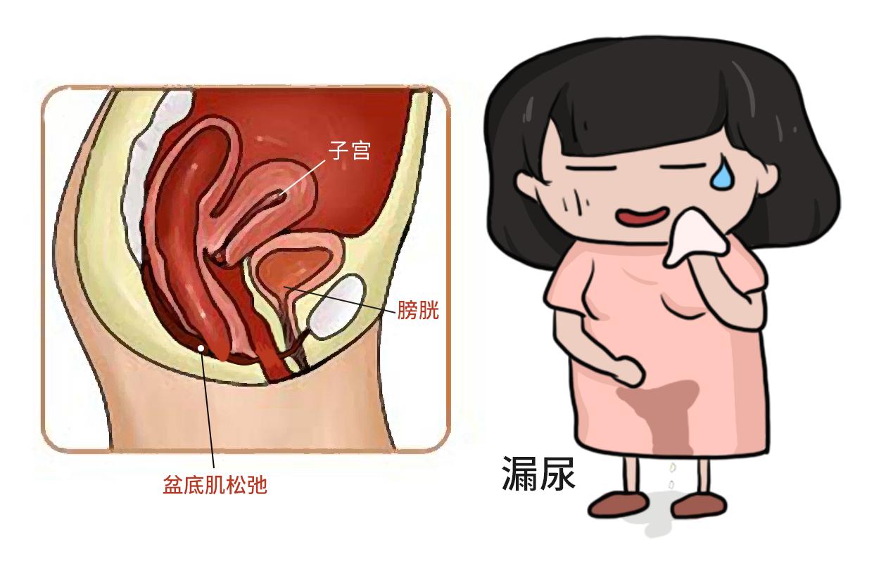 盆底肌松弛漏尿图片（盆底肌松弛漏尿如何做运动带图）