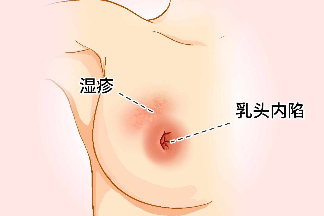 不正常乳头图片及周围颜色 不正常乳头图片及周围颜色是什么