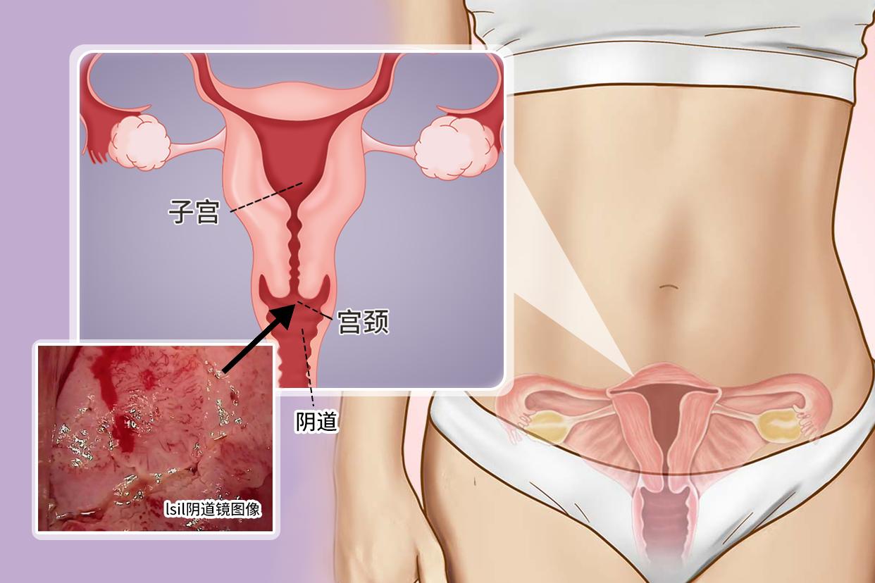 lsil阴道镜图像的特征