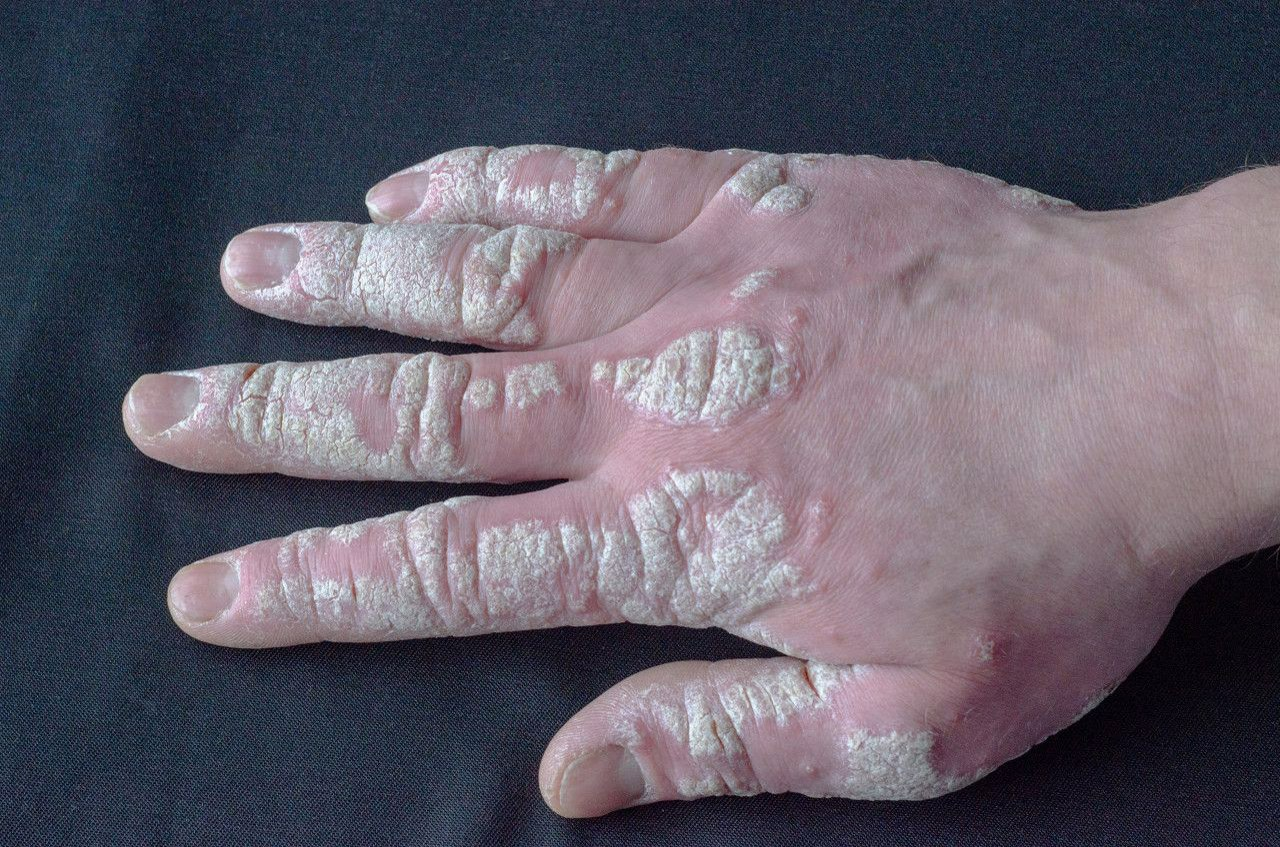 手指银屑病关节炎图片 手指银屑病关节炎多长时间消肿