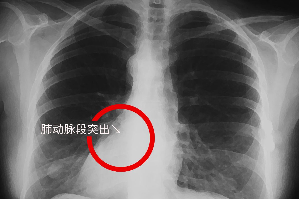 胸片肺动脉段突出图片 胸片肺动脉段突出图片高清