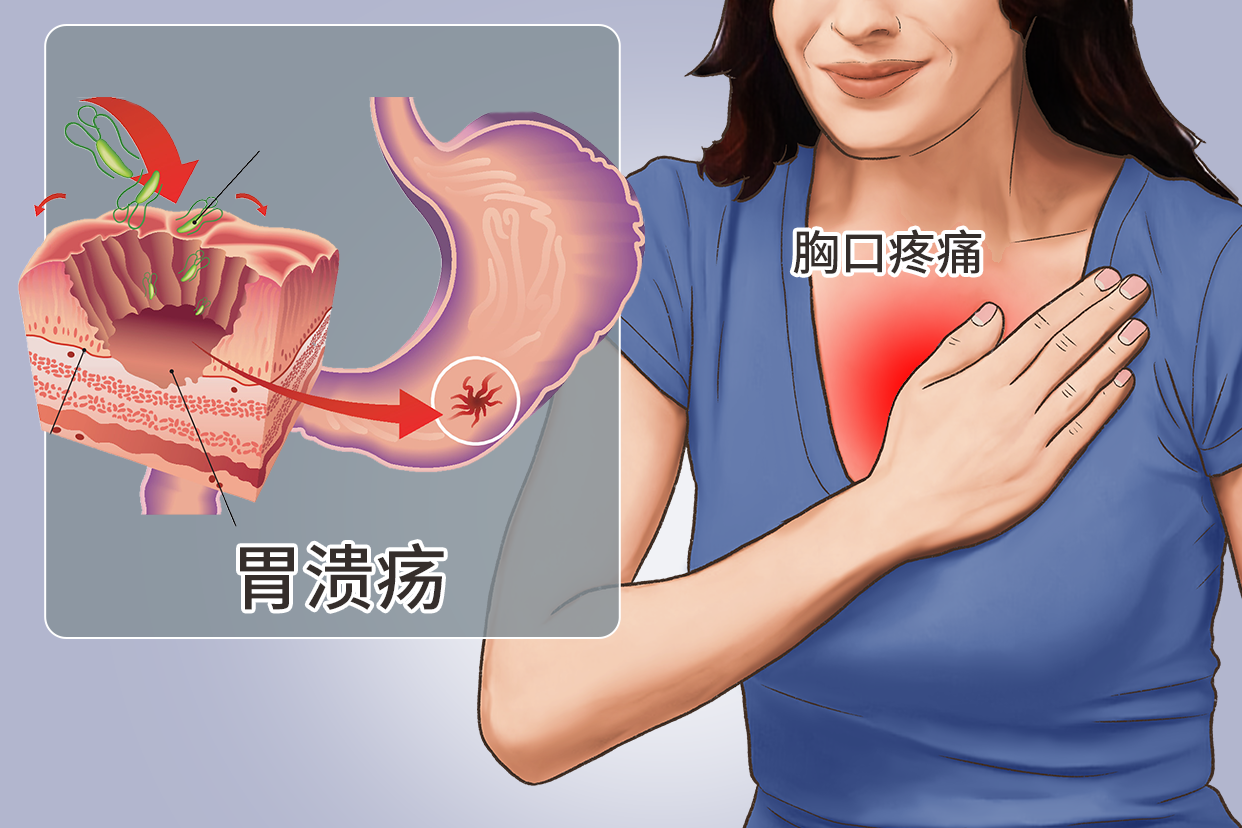 胃溃疡胸口疼位置图 胃溃疡胸腔疼