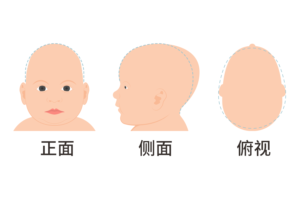 婴儿头两侧有凹陷怎么回事图片 婴儿头两侧有凹陷怎么回事图片