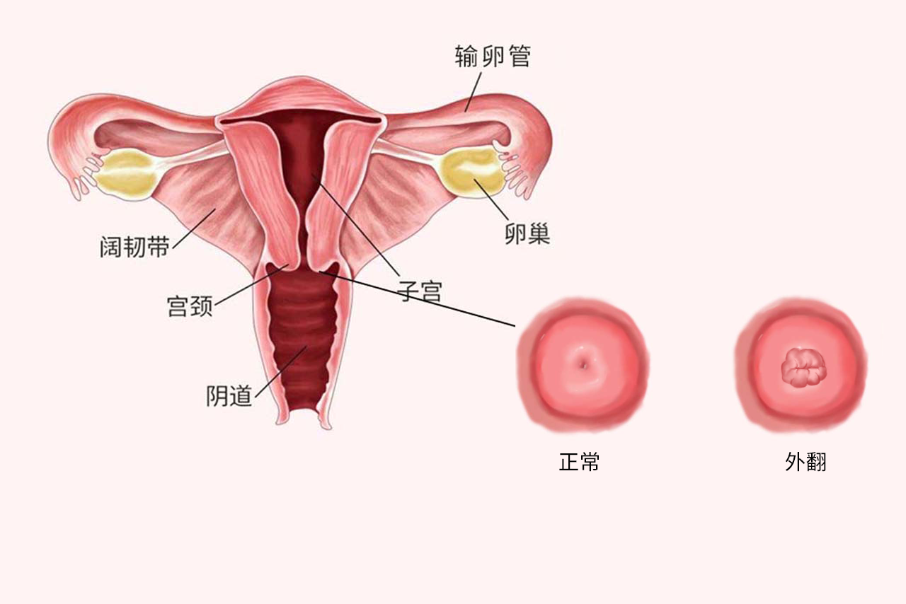 宫颈外翻图片（宫颈口有一坨肉凸出来）