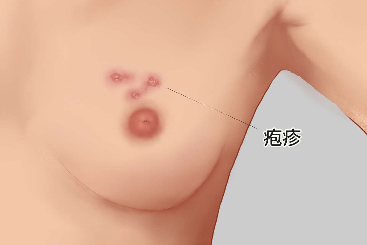 女性乳房长疱疹图样（乳房上生疱疹）