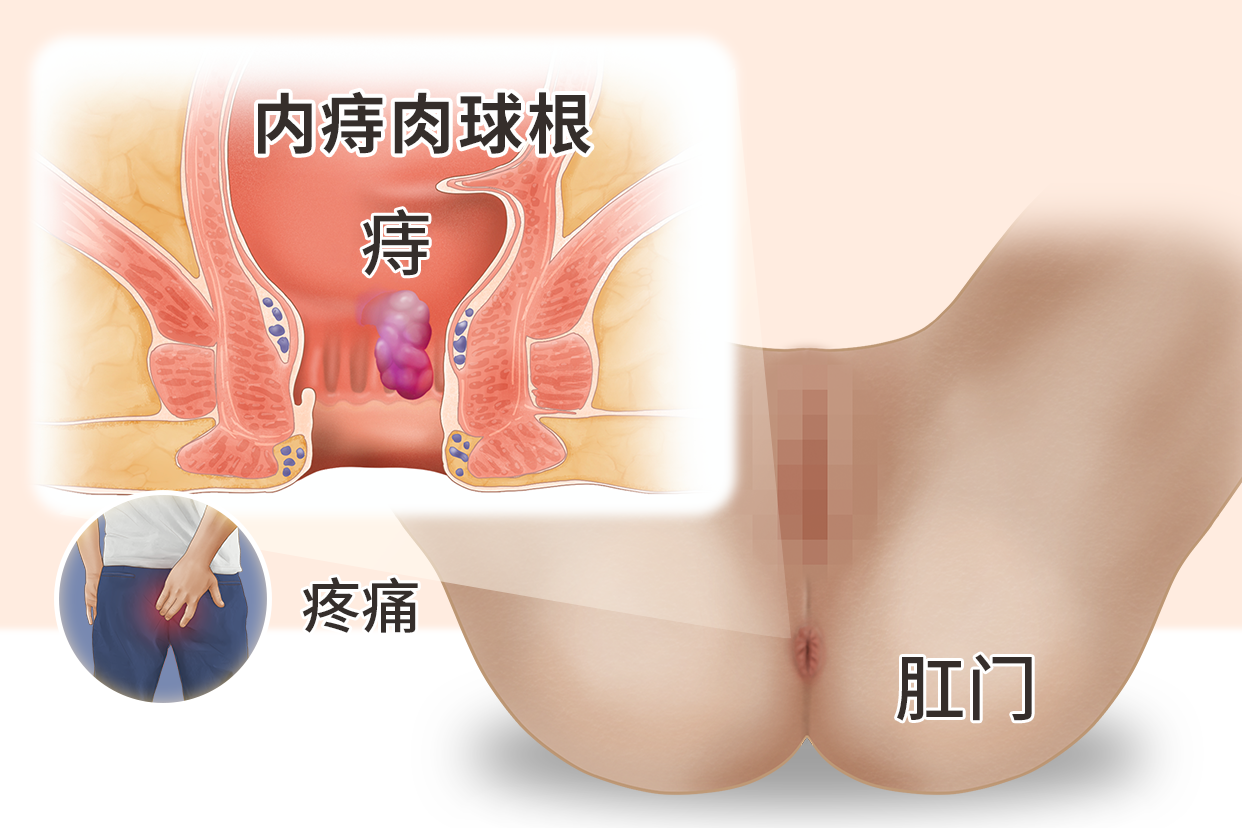 痔疮肉球有根筋疼是肉球根吗图片 痔疮肉球有根筋疼是肉球根吗图片