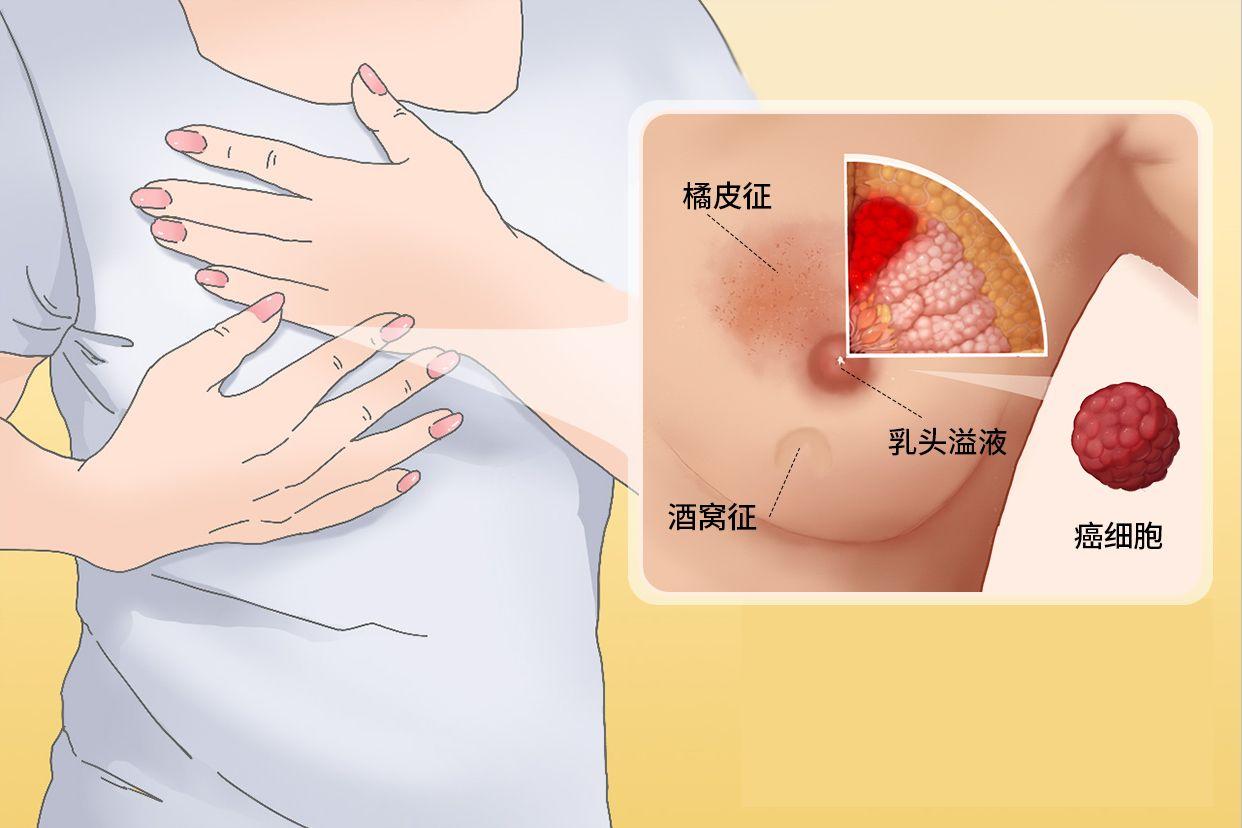 乳腺癌的真实图片高清 乳腺癌的真实图片高清