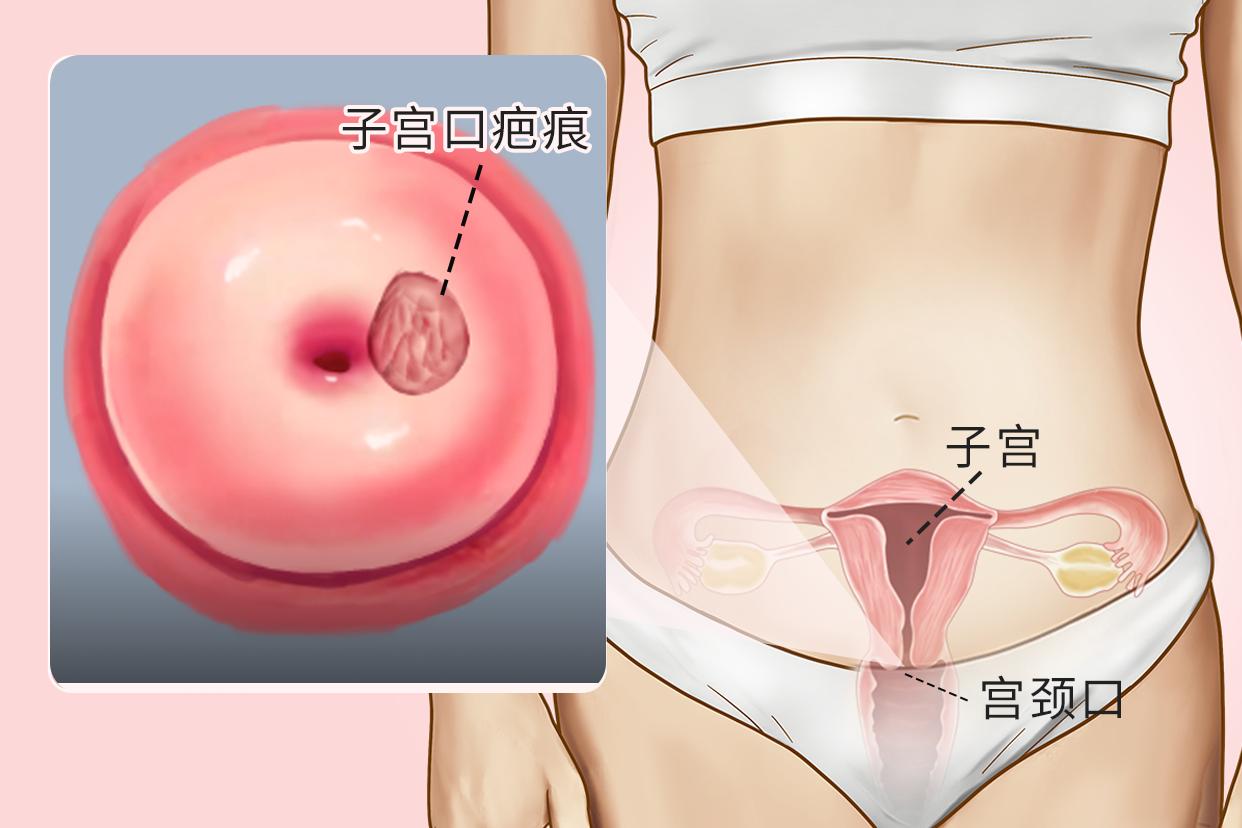 子宫口疤痕图片 子宫口疤痕图片