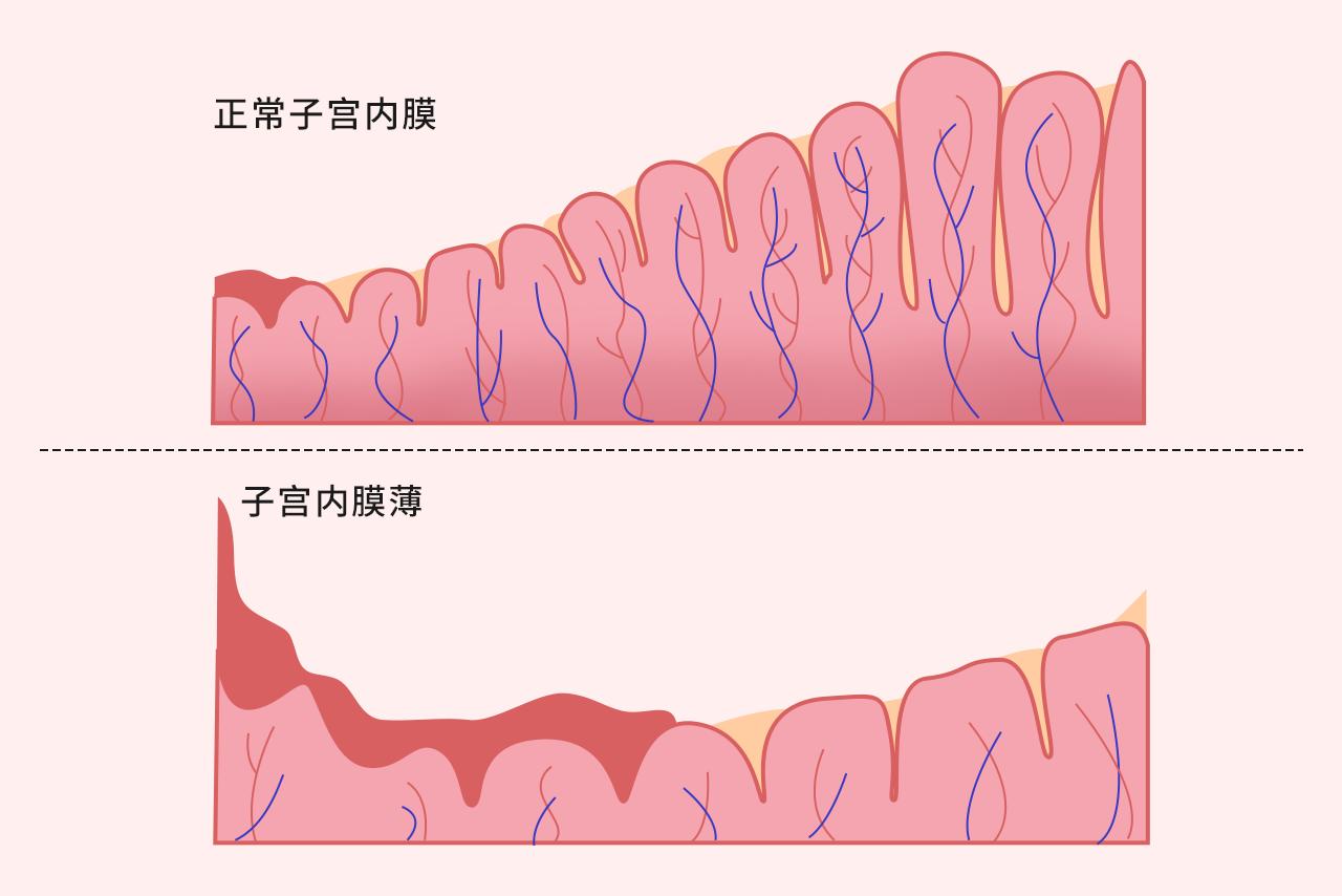 子宫内膜薄图片