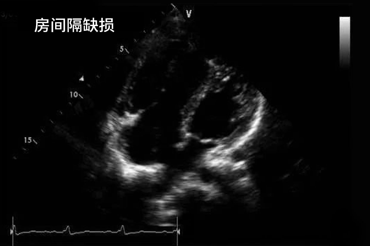 房间隔缺损超声心动图的特征