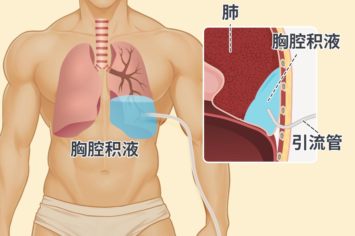 胸膜炎伤口引流管的位置图片